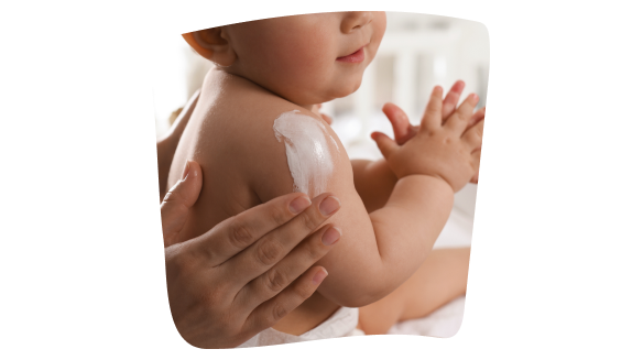 Aplicación de crema hidratante sobre la piel atópica de un bebé. Aplicación de crema hidratante sobre la piel atópica de un bebé.